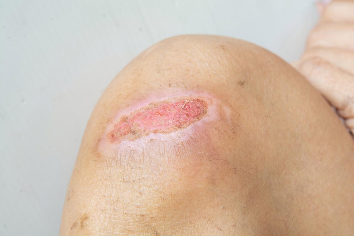 医用粘胶为何会损伤皮肤?