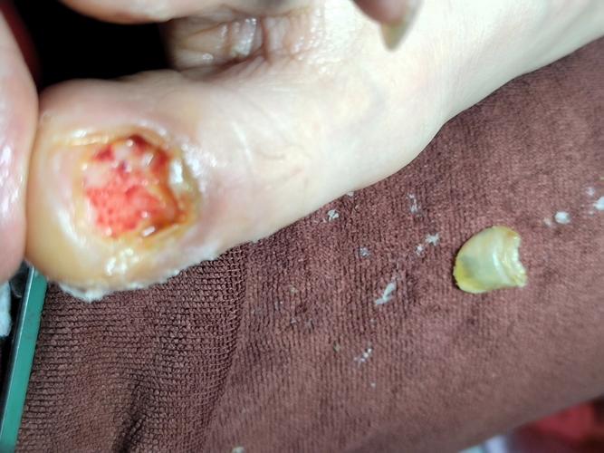 皮肤烂了个洞怎么处理?