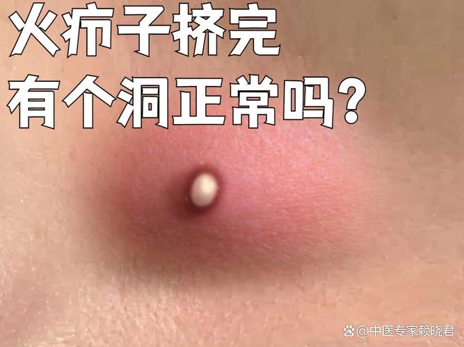 皮肤烂了个洞怎么处理?