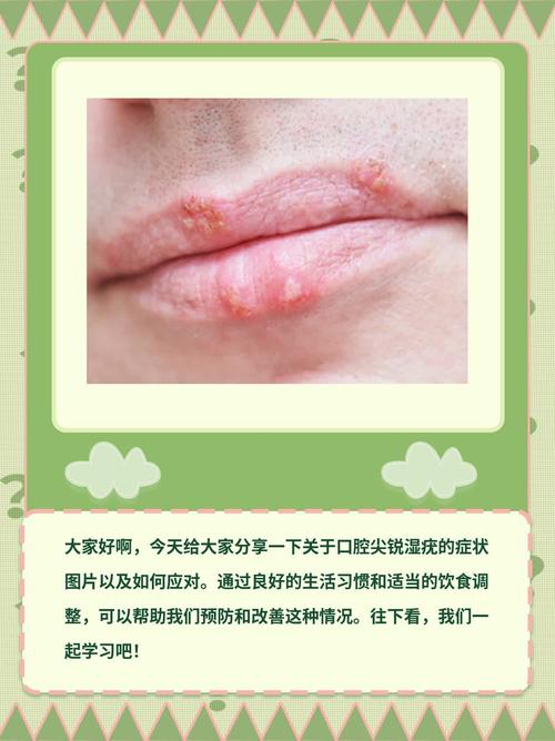 舌头口腔尖锐湿疣如何处理?