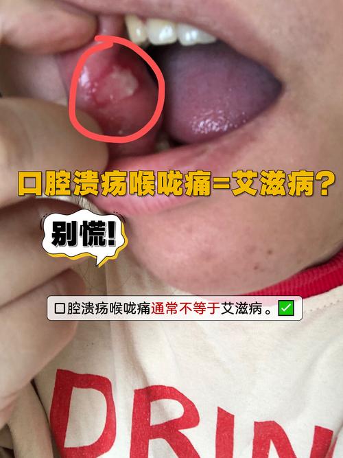 艾滋病男性口腔症状图片有哪些典型表现?