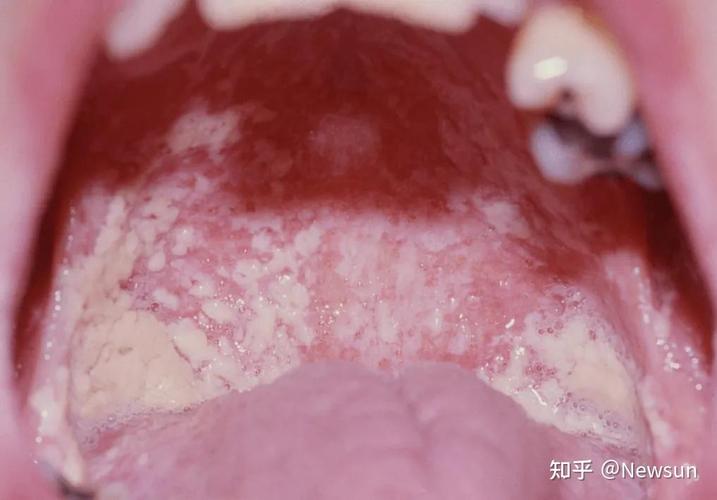 艾滋病男性口腔症状图片有哪些典型表现?