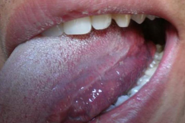 艾滋病男性口腔症状图片有哪些典型表现?