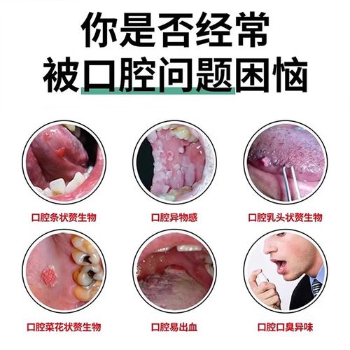 治疗口腔尖锐口服药有哪些?