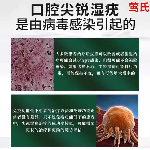 治疗口腔尖锐口服药有哪些?