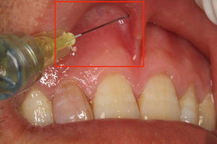 口腔前庭沟进针点图片如何定位?