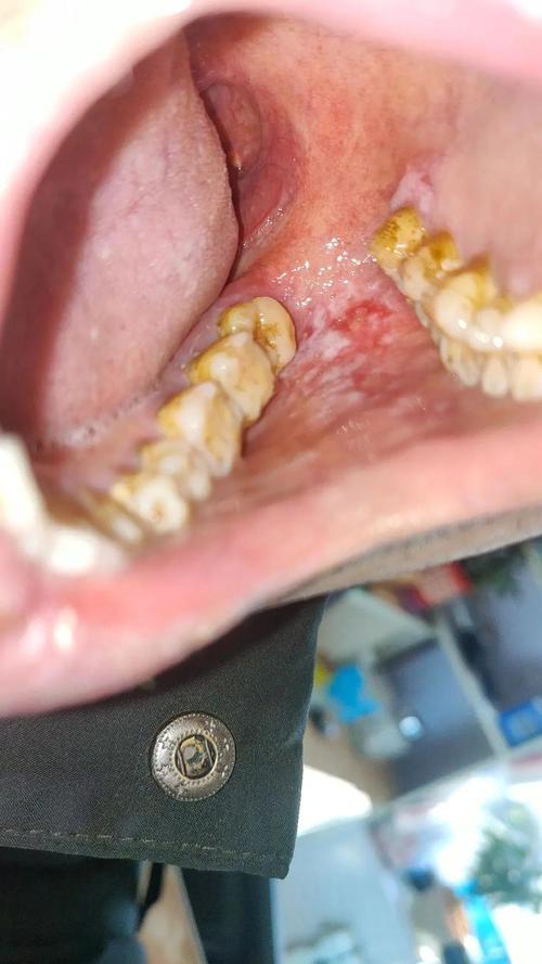 慢性口腔炎症状有哪些?