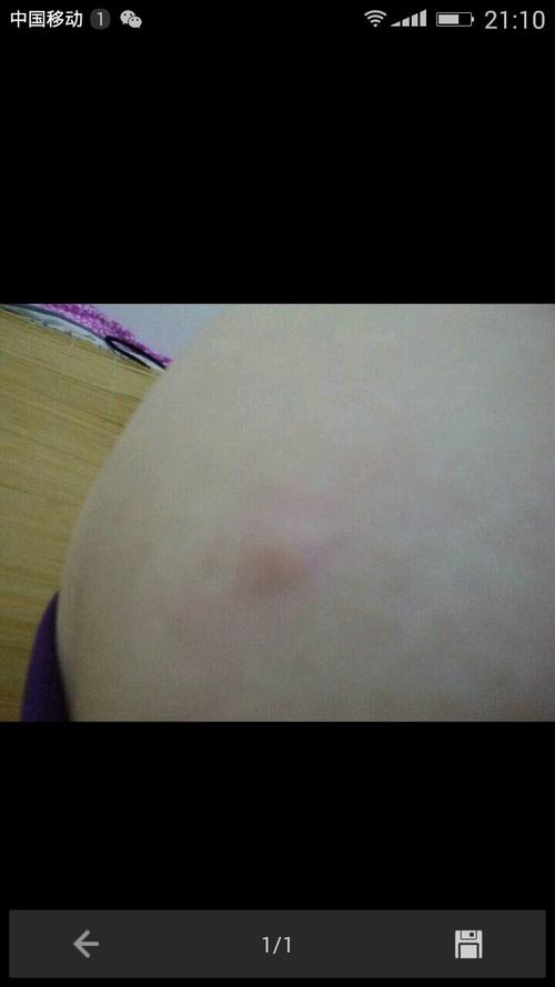 皮肤黑色硬疙瘩是何问题?需警惕吗?