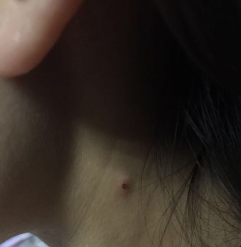 皮肤黑色硬疙瘩是何问题?需警惕吗?