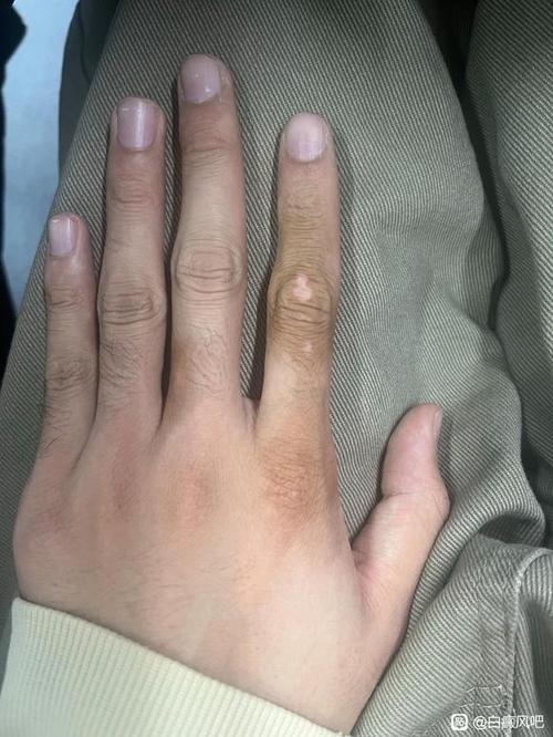 手上皮肤为何一块白一块黑?