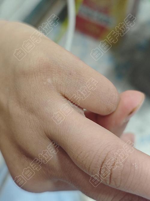 手上皮肤为何一块白一块黑?