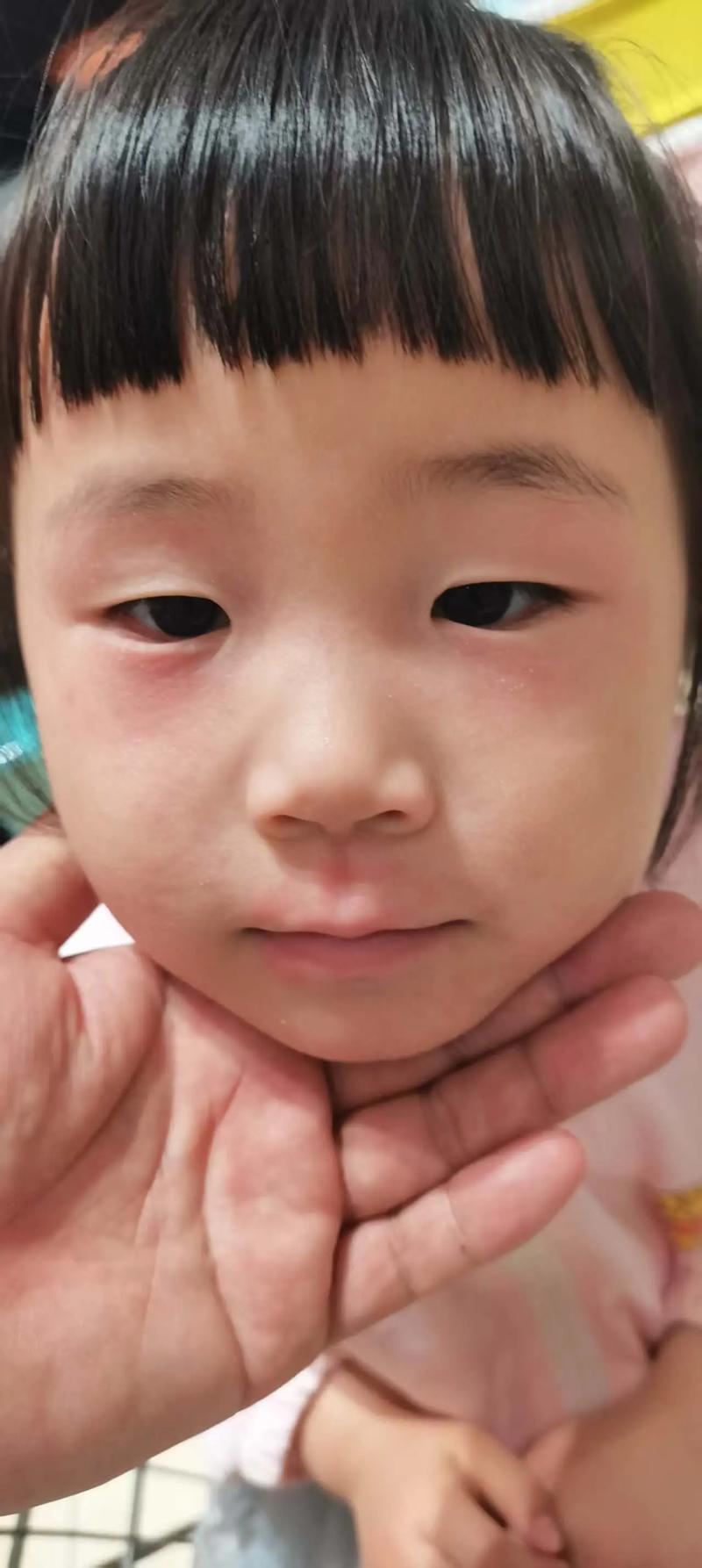 小孩皮肤过敏几天能好?