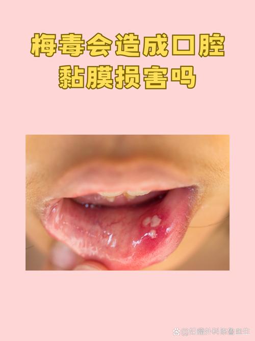 咬破口腔内壁,反复发作危害大吗?