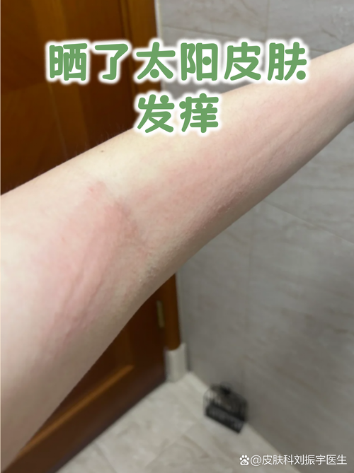 皮肤过敏晒太阳会加重吗?