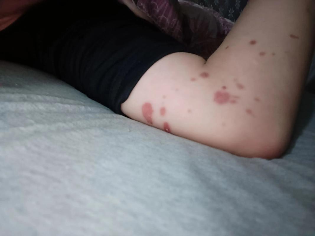 油溅到皮肤变红怎么办?