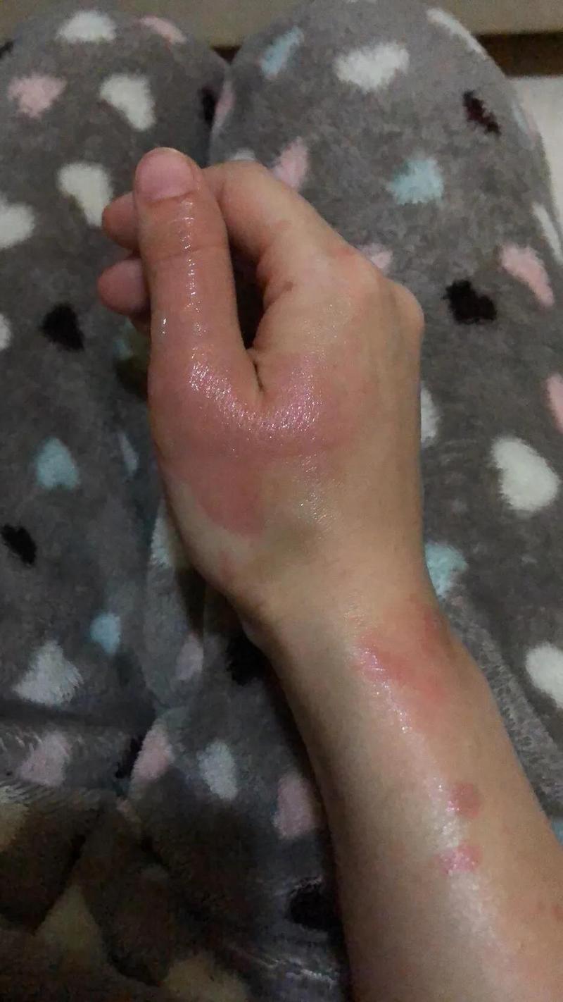 油溅到皮肤变红怎么办?