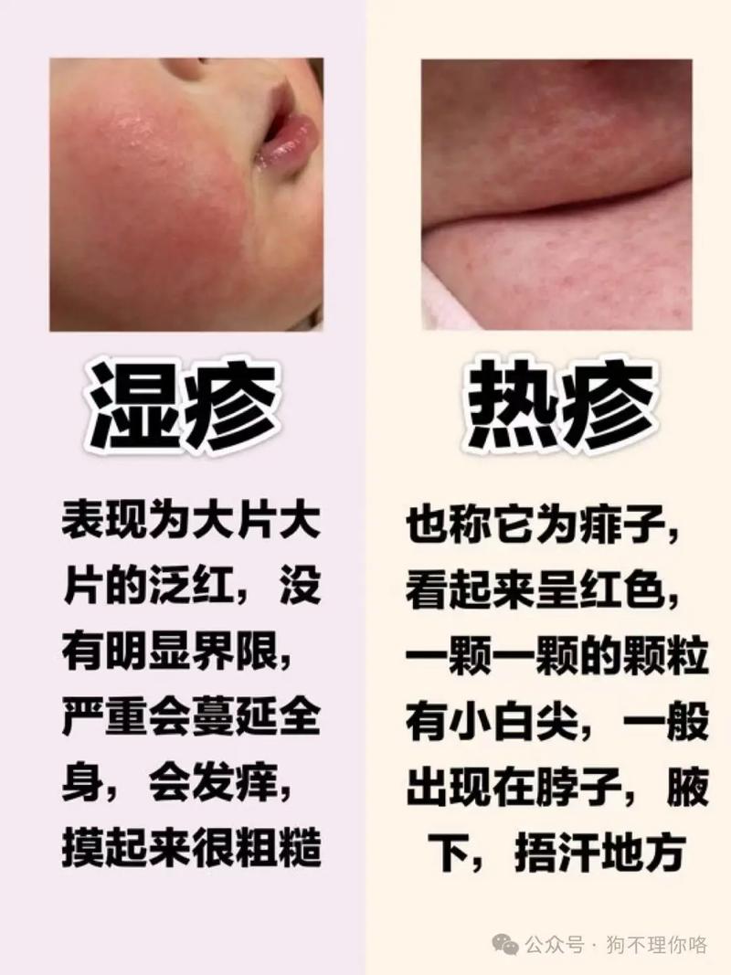 湿疹诱因复杂,究竟哪些是主因?