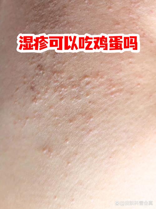 皮肤瘙痒能吃鸡蛋吗?