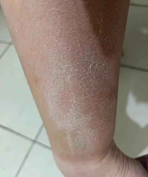 冬季皮肤干燥起皮瘙痒
