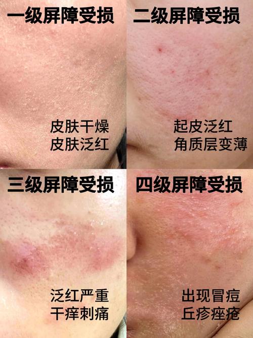 冬季皮肤干燥起皮瘙痒