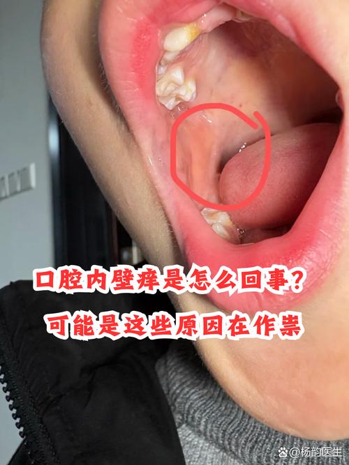 口腔反复起泡是上火还是疾病信号?
