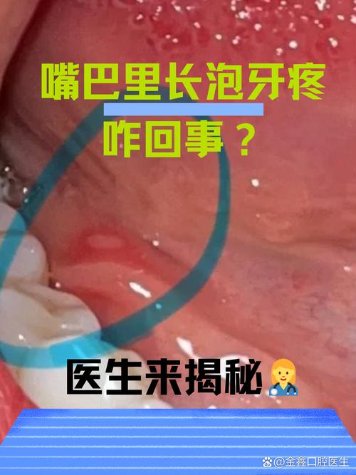 口腔反复起泡是上火还是疾病信号?