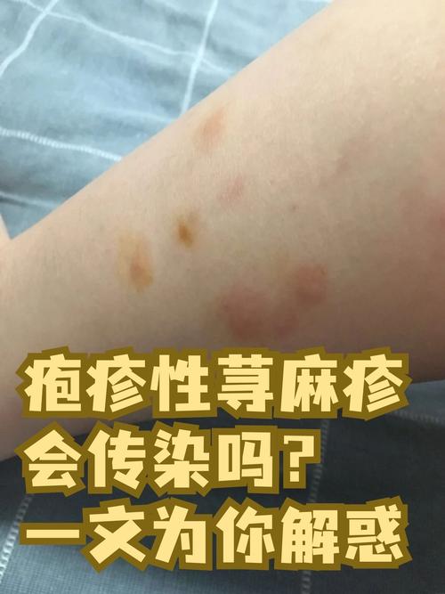 皮肤病到底会不会传染?
