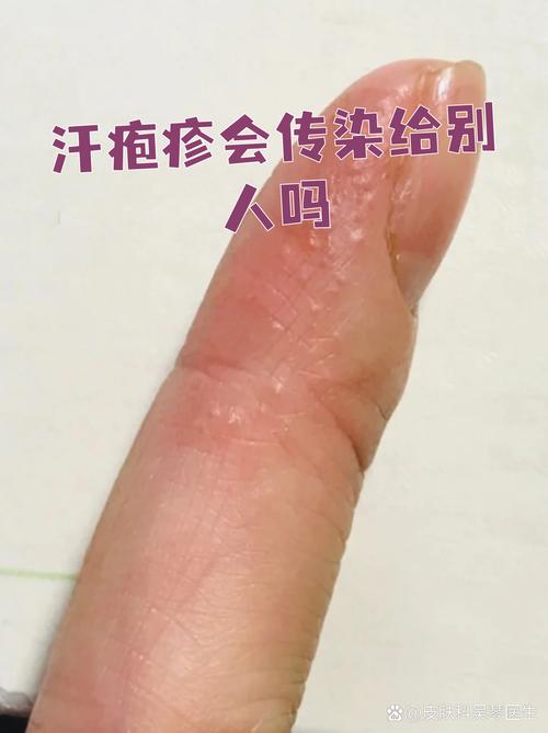 皮肤病到底会不会传染?