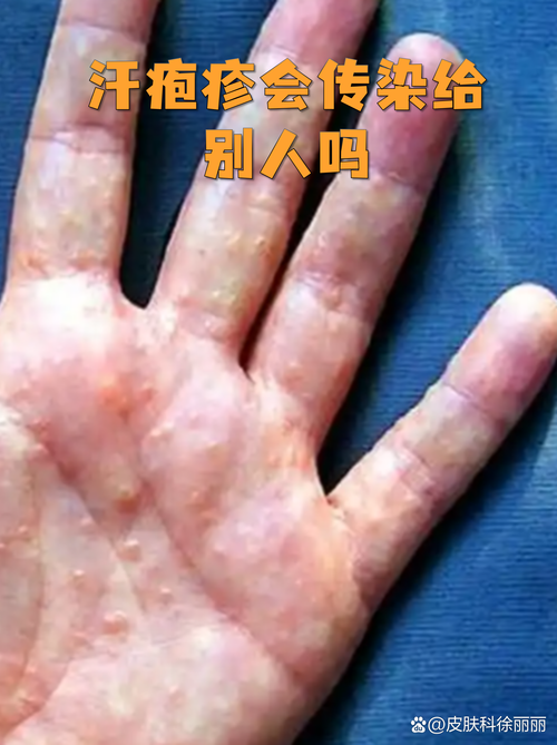 皮肤病到底会不会传染?