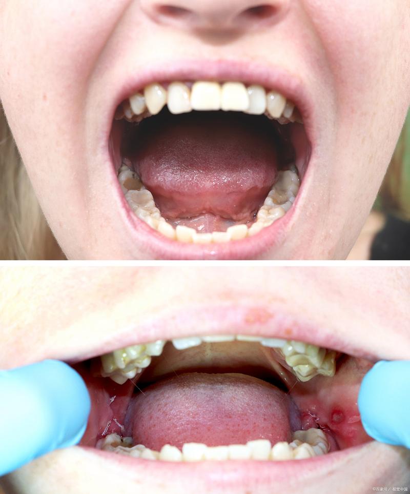 印度女孩口腔长满牙,这是罕见病症吗?