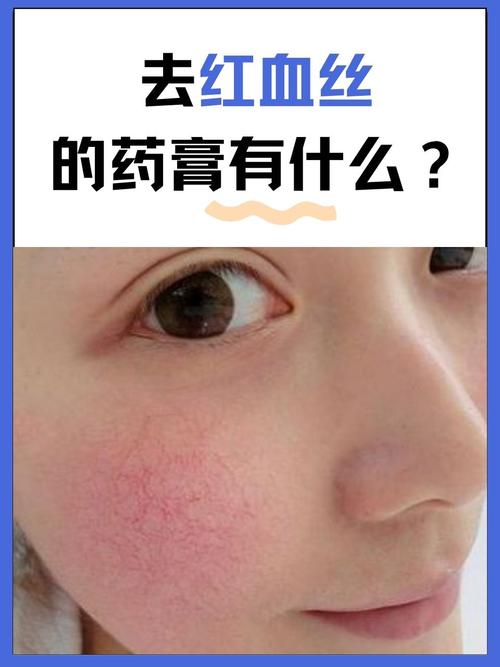 薄脸皮红血丝如何消?