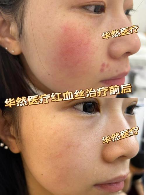 薄脸皮红血丝如何消?