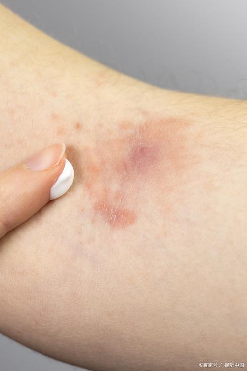 晒后皮肤红痒怎么办?