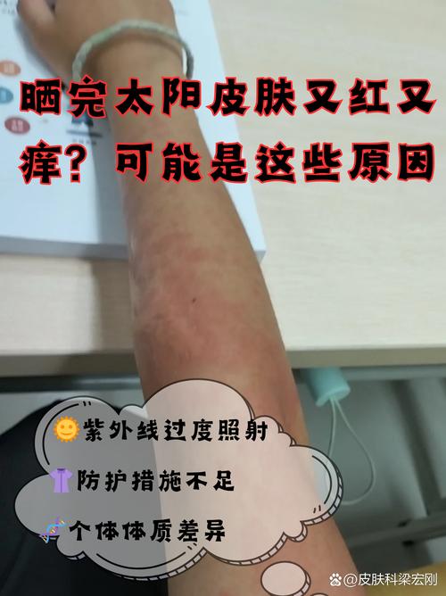 晒后皮肤红痒怎么办?