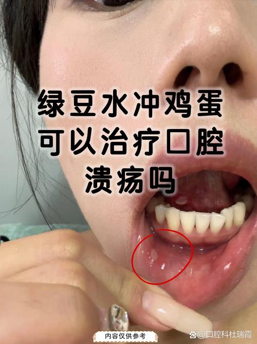 口腔黏膜渗出液怎么取才准确?