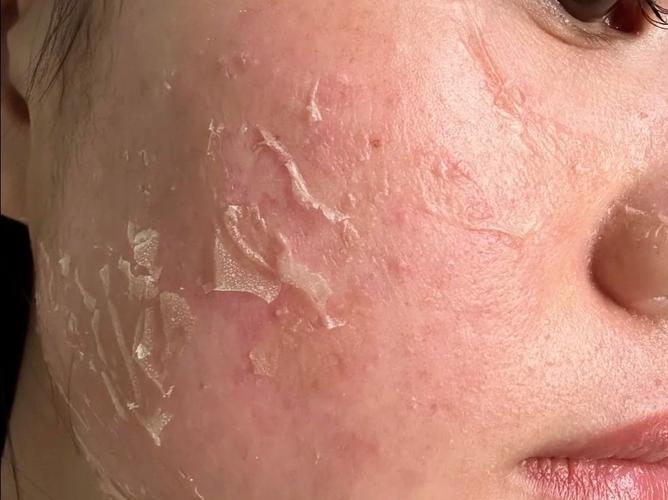 冬天脸部干燥起皮,该怎么有效修复?