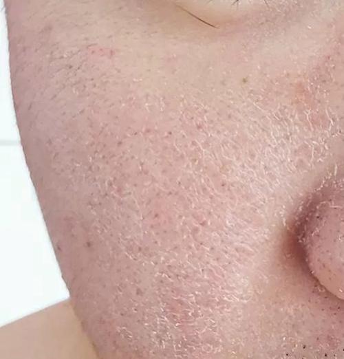 冬天脸部干燥起皮,该怎么有效修复?