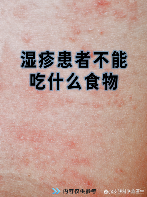 皮肤过敏能喝奶茶吗?