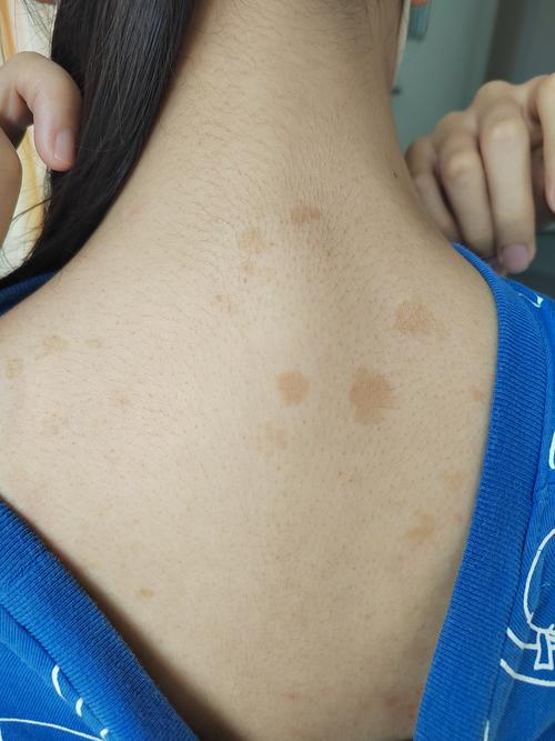 后背皮肤发黑粗糙是何原因?