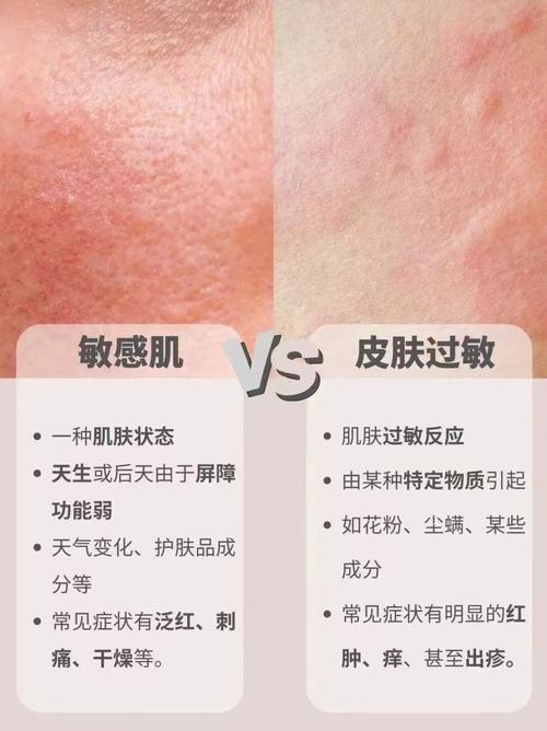 皮肤过敏用盐水洗会加重吗?