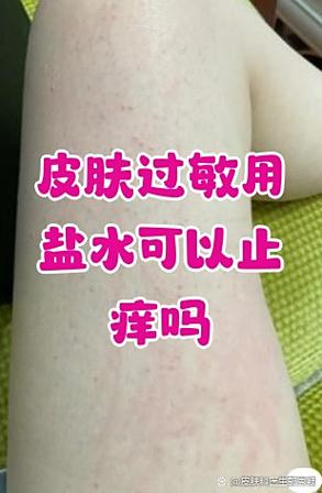 皮肤过敏用盐水洗会加重吗?