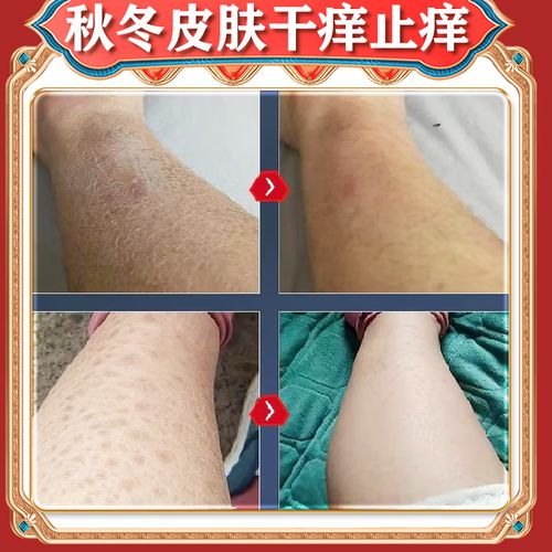 冬季皮肤干痒,抹药还是口服药?