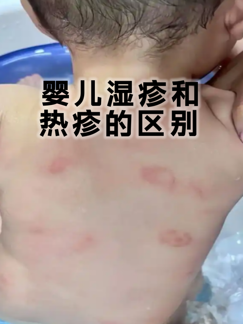 婴儿皮肤过敏,如何科学处理?