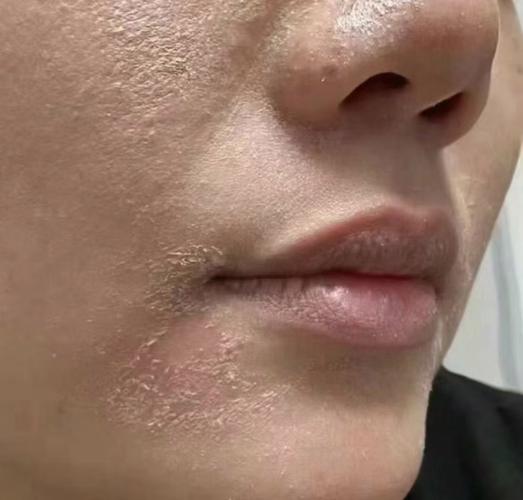 冬天脸上干脱皮,怎么办?