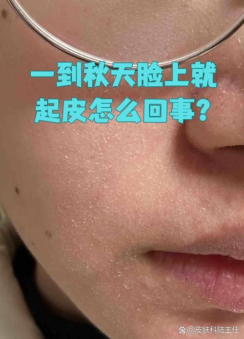 冬天脸上干脱皮,怎么办?