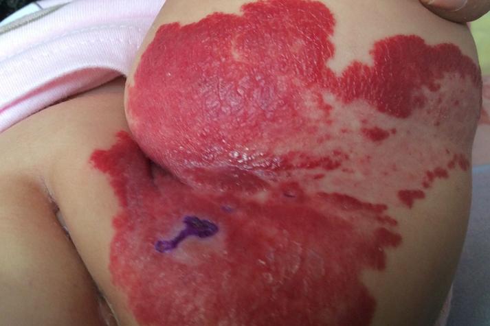 皮肤红血点是什么原因?需警惕哪些疾病?