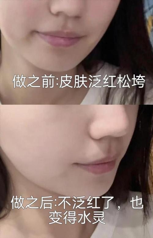 光子嫩肤会让皮肤变薄吗?