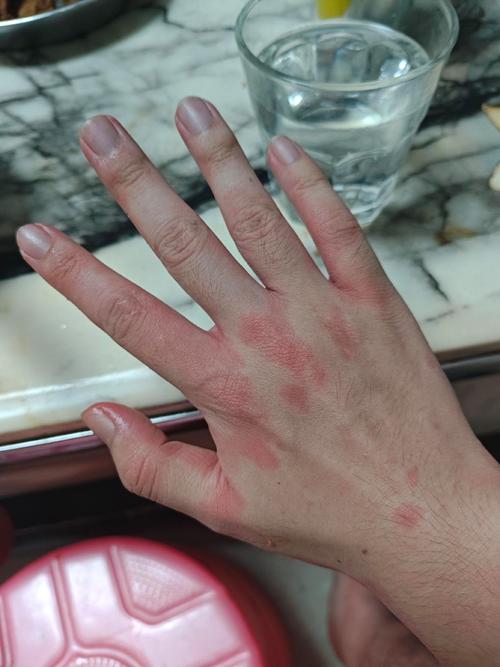 皮肤酒精过敏了,该怎么快速处理?