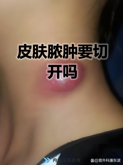 皮肤长脓包是感染还是其他原因?