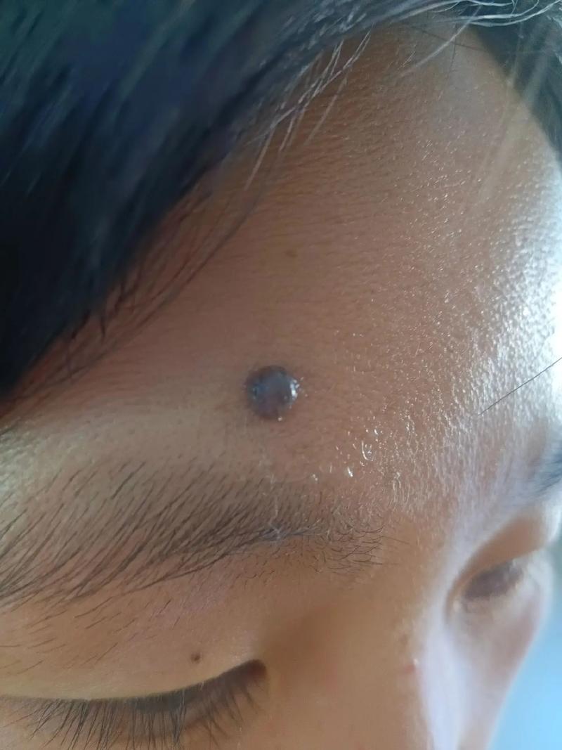 皮肤上的突出痣是什么痣?